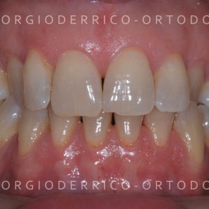 Caso ortodonzia linguale 3