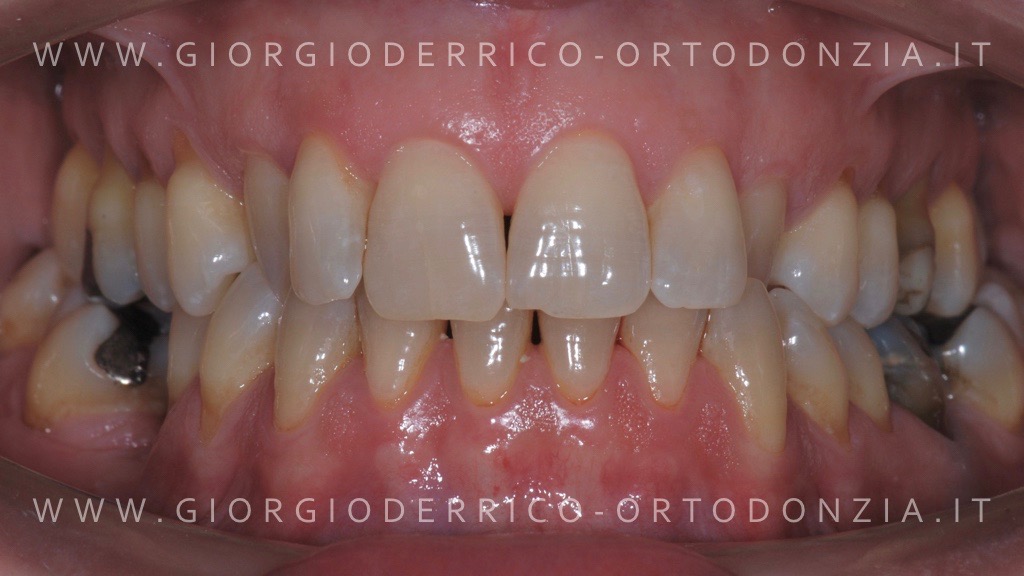 Caso ortodonzia linguale 3