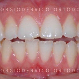 Caso ortodonzia linguale 1