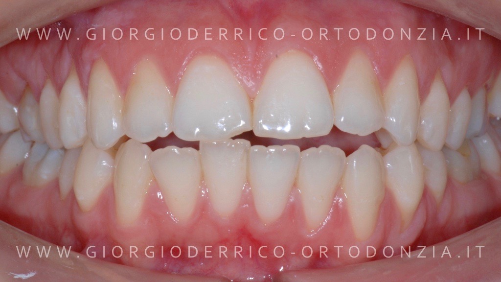 Caso ortodonzia linguale 1