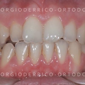 Caso ortodonzia linguale 2