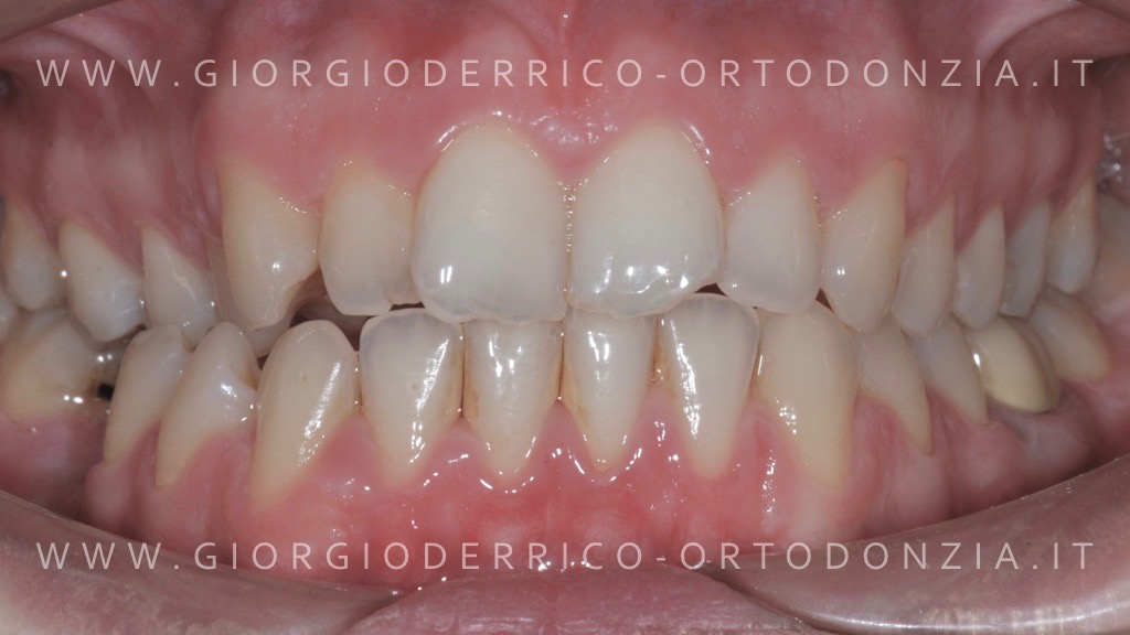 Caso ortodonzia linguale 2